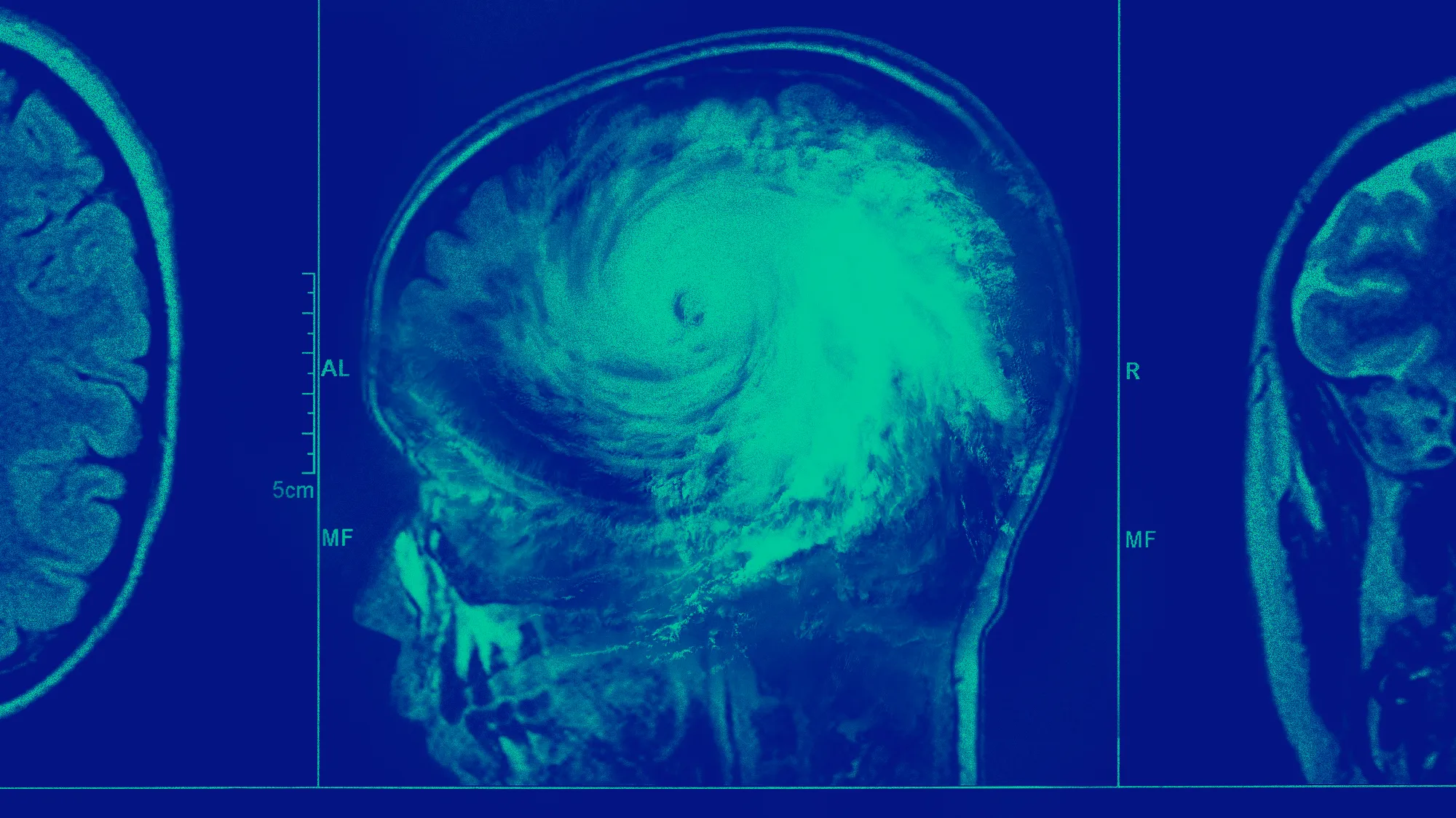 A brain scan with a hurricane in it